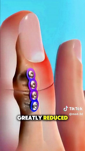 Finger fusion surgery #finger #fingerfusion #fingerchallenge #medicalanimation #handsurgery
