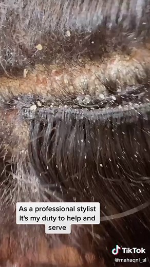 Understanding Scalp Psoriasis: Treatment and Removal Tips