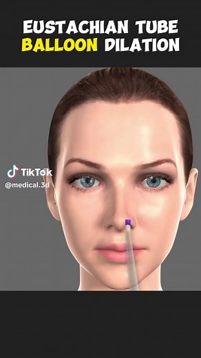 Eustachian Tube Balloon Dilation: 3D Animation Explained