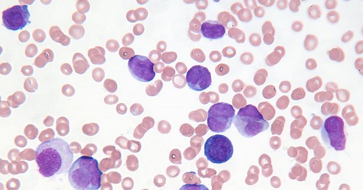 Leukämie: Symptome und Lebenserwartung bei Blutkrebs