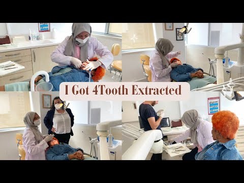 4 TEETH 🦷 EXTRACTED!! FOR BRACES | Healing ❤️‍🩹 UPDATE
