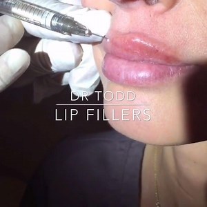 See What a Juvederm Lip Injection Procedure Is Like