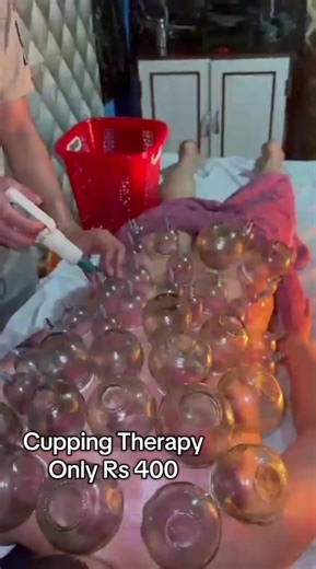 Cupping Therapy #Cupping #Therapy #chinesetreatme #foryou #AcupunctureTCM