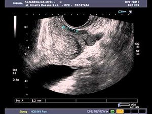 Biopsia ecoguidata transrettale piccolo nodulo prostatico