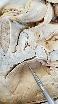 Have You Heard About Rectocele