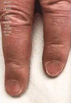 QUINCKE'S PULSE...Alternate flushing and blanching of nail beds in AORTIC REGURGITATION. Anybody se