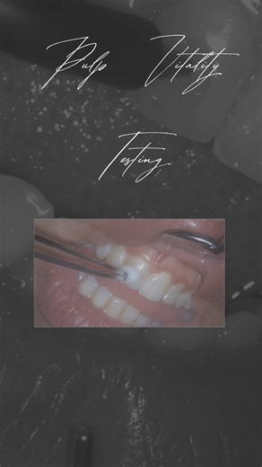 Dr Nayef Younes on Instagram‎: "🦷 Pulp Vitality Testing 🧊 Cold Test ⚡ Electric Pulp Test Cold Test & EPT are essential tools to assess pulp vitality and guide proper endodontic diagnosis and treatment. 🔹 اختبار البرودة (Cold Test) 🔹 اختبار اللب الكهربائي (EPT) هما أدوات أساسية لتقييم حيوية لبّ السن والمساعدة في التشخيص الصحيح ووضع الخطة العلاجية المناسبة لعلاج جذور الأسنان 𝐑𝐨𝐨𝐭 𝐜𝐚𝐧𝐚𝐥 𝐒𝐩𝐞𝐜𝐢𝐚𝐥𝐢𝐬𝐭 🦷🔬 𝐃𝐫.𝐍𝐚𝐲𝐞𝐟 𝐘𝐨𝐮𝐧𝐞𝐬 To book an appointment or for any inquiries ,