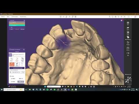 Smilecloud and exocad integration with Resin Bonded Bridge