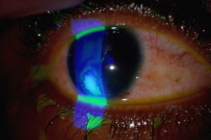 What is corneal abrasion and how to treat it | Emergency Live
