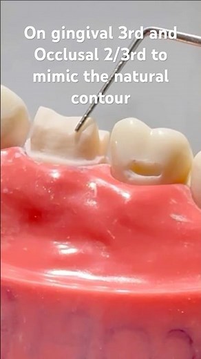 🦷 Two-plane reduction — for perfect contour and crown strength! |Dr.Dentique-hub