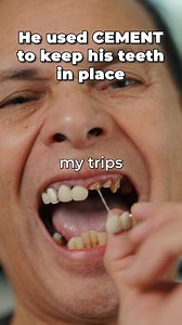 6.6K views · 26 reactions | 勞醴 He Used Cement To Keep His Teeth In...