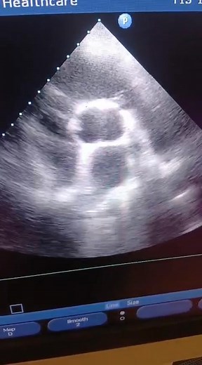 Bicuspid Aortic Valve (BAV) 1--Definition & Overview A bicuspid aortic valve is a congenital cardiac malformation in which the aortic valve has two cusps instead of three (tricuspid). It is the most common congenital cardiac anomaly, affecting 1–2% of the population, more common in males (≈3:1 ratio). Usually discovered incidentally on echocardiogram or after developing a murmur or complications. --- 2--Embryology Normally, the aortic valve develops from endocardial cushions and truncoconal swel