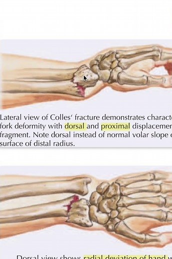 Colles fracture - dinner fork deformity #doctor #medicalstudent #anatomy
