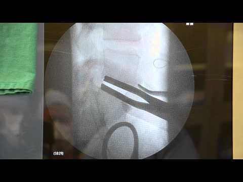 Lumbar Artificial Disc Replacement Surgery, Synthes Prodisc-L