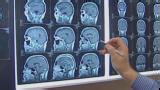 Researchers create at-home smell test to detect Alzheimer’s | Morning in America