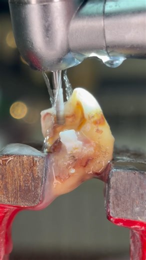 Inside a Decayed Tooth: Extreme Dental Cleaning #dentalcare #satisfying #wisdomtoothextraction