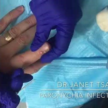 Drainage of Paronychia (collection or small abscess due to infection) around the nailbed