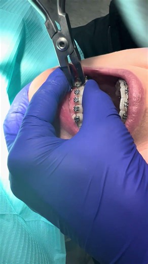Braces removal video