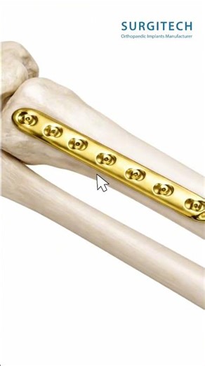 A comprehensive range for reliable fracture fixation — #shorts