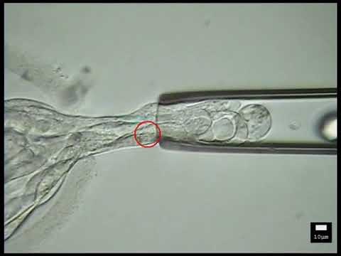 IVF - Embryo Biopsy Procedure Tests Embryos For Genetic Abnormalities