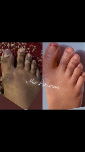 Effective Dark Feet Treatment in Just 2 Weeks