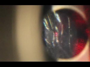 YAG through IC-8 - Eyetube