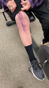 #totalkneereplacement #knee | Total Therapy Solutions: Physical Therapy