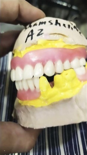Teeth Arrangement Of Upper Lower Removable Partial Denture 😁😁😁#rpddentalprocedure#viralvideo