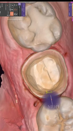 Daniela Torres / EXOCAD - Digital Dental Designer | crown design ✨ #exocadexpert #exocad #dentaldesign #digitaldentistry #dentaldesignsmile #cadcam #cadcamdentistry #odontologo | Instagram