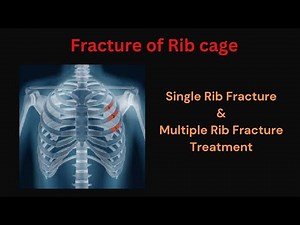 Ribs Fracture | Rib fracture Treatment at home | Single & Multiple Rib Fracture Treatment |