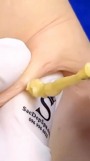 Pimple Popping Videos on Instagram: "⚠️ Caution ⚠️ it’s a juicy one 😍 #cyst #pimplepopper #pimples"