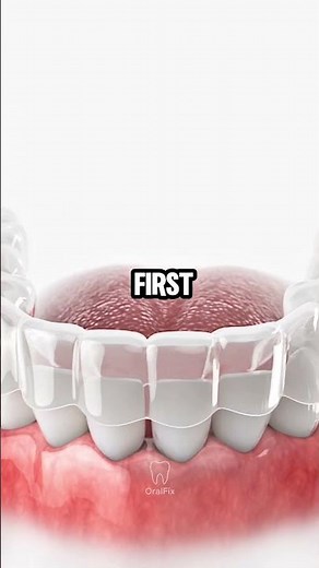 Why Your Teeth Move After Braces Come Off 🦷➡️ And How a Retainer Stops It #retainer