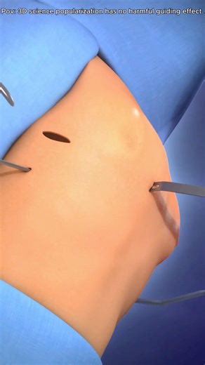 Pectus Excavatum And Nuss Procedure (3D Animation) #pectusexcavatum#pectusexvactum