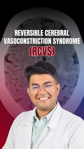 Dr Abhishek Bhargava | Neurologist | Sudden, severe headache? Don’t ignore it. RCVS (Reversible Cerebral Vasoconstriction Syndrome) is a condition where brain blood vessels... | Instagram