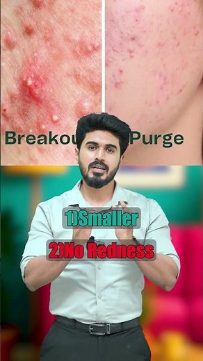 Trying new skincare & seeing tiny bumps? 🤔 Purging or Pimples, know the difference!#beardgrowth
