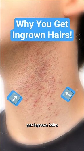 Why You Get Ingrown Hairs!