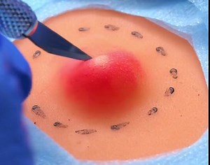 Massive Boil Drained Safely! Medical Extraction in Action | Wood Mood