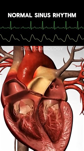 Aabid Khan Rj on Instagram: "ECG rhythms with Heart Animation (Normal sinus rhythm, Ventricular Tachycardia, Ventricular Fibrillation, Asystole) Aabid Khan Rj"