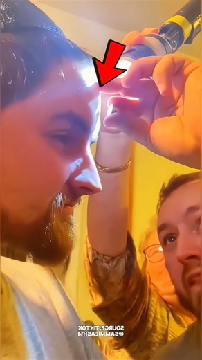 Metal Extraction From Skin Using a Powerful Magnet