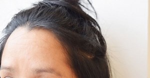 The BEST Cure For Dandruff (Just 1 Cheap Ingredient!)