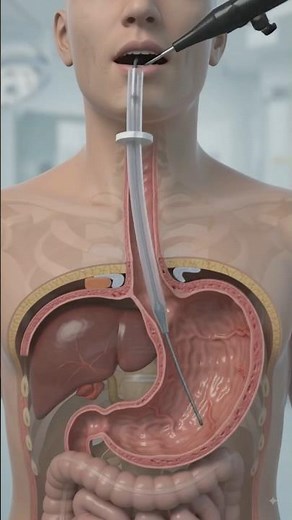How is a Feeding Tube Surgery (PEG Tube Placement) performed? In this 3D medical animation,