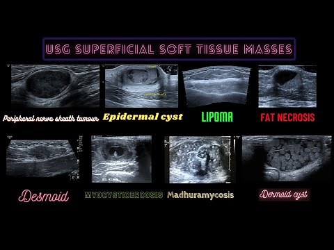 ULTRASOUND OF SUPERFICIAL SOFT TISSUE MASSES