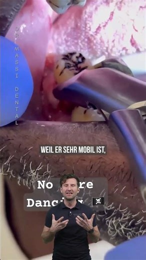 This is a molar extraction. #shorts