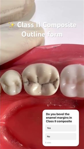 Class II Composite Outline Form | Dr.Dentique-hub