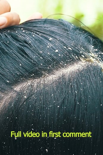 15K views · 52 reactions | Extreme dandruff scratching #dandruff #scalpcheck | I'm Dandruff | Facebook