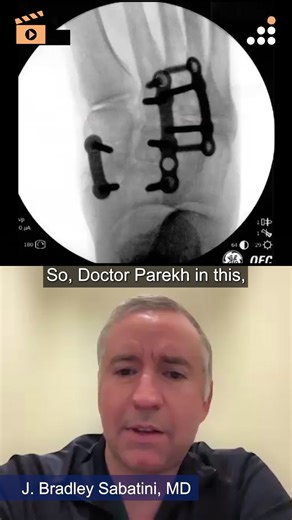 CONMED - Sabatini CC 1 - Enhanced Compression in Midfoot Fusion with NeoSpan Compression Implant System