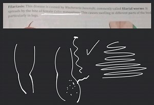 Filariasis: This disease is caused by Wuchereria bancrofti, com... | Filo