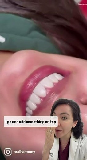 How Does No Prep Veneer Work?!