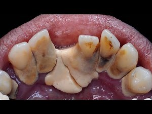 I Advised Her To Get Her Tooth Pulled Out, But She Refused | 48yo Female | Dokter Gigi Tri Putra