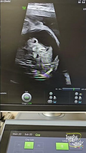 Fetal Echogenic Bowel & Ascites || Ultrasound